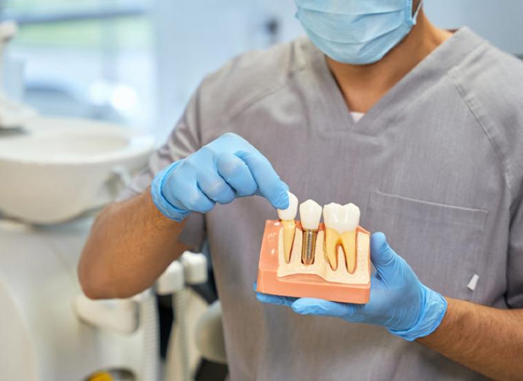 Όλα όσα πρέπει να γνωρίζετε για τα οδοντικά εμφυτεύματα